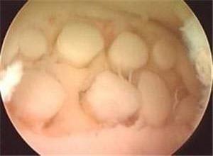 复发性多软骨炎