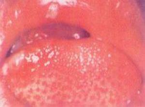 复发性坏死性黏膜周围炎