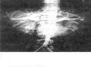 腹主动脉腔静脉瘘