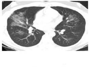 肝肺综合征
