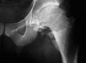 骨血管外皮细胞瘤