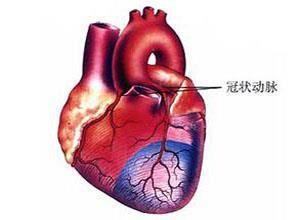 冠状动脉异常起源于肺动脉