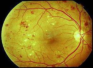 获得性视网膜大动脉瘤