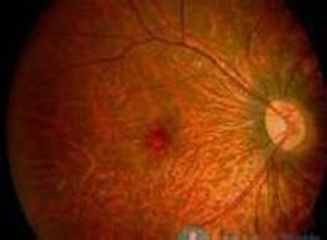 急性视网膜色素上皮炎