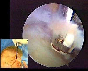 肩胛上神经卡压症