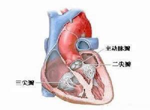 主动脉瓣狭窄合并关闭不全