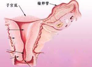 卵巢宫内膜样肿瘤
