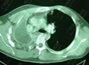 卵巢未成熟畸胎瘤