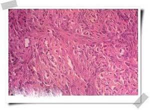 卵巢硬化性间质瘤