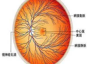 脉络膜脱离型视网膜脱离