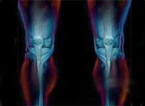 尿黑酸尿与褐黄病