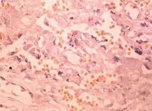膀胱嗜铬细胞瘤