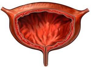 膀胱输尿管反流