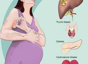 妊娠期肝内胆汁淤积症