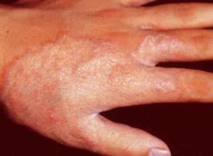 砷及其化合物引起的皮肤病