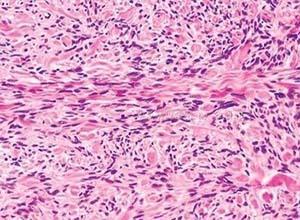 梭形细胞脂肪瘤