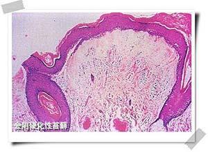 外阴硬化性苔藓