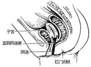 先天性肛门直肠畸形