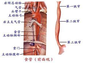 先天性食管狭窄