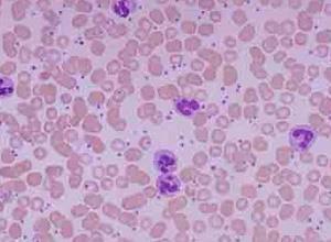 小儿白细胞黏附分子缺陷Ⅰ型