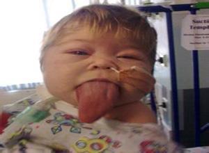 小儿伯-韦综合征