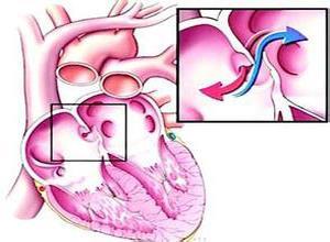 小儿低心排出量综合征