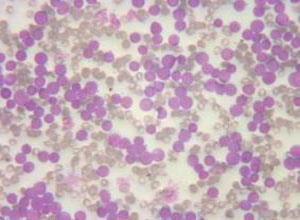 小儿非内脂性网状内皮增殖综合征