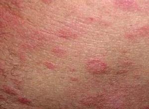 小儿结节性脂膜炎