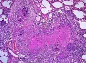 小儿郎格罕细胞性组织细胞增生症