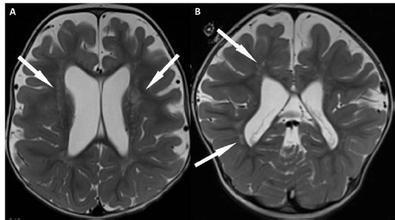 小儿良性先天性肌弛缓综合征