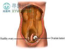 小儿卵巢肿瘤