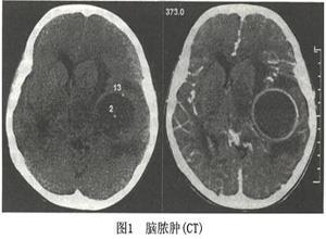 小儿视网膜母细胞瘤