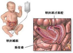 小儿粘连性肠梗阻