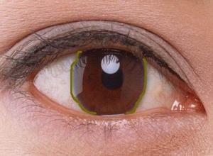 眼眶骨化纤维瘤