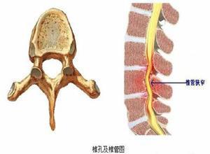 腰椎椎管狭窄症