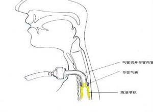 医源性气管及主支气管损伤