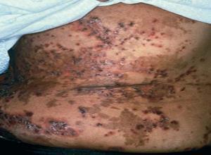 胰高糖素瘤综合征