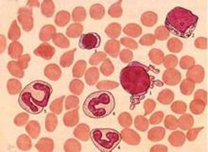 异常γ-球蛋白血症