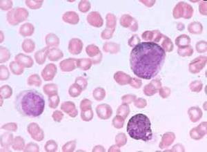 幼年型慢性粒细胞白血病
