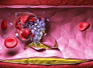 原发性纤维蛋白溶解症