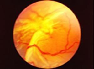 增生性玻璃体视网膜病变
