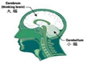 自发性脑室内出血