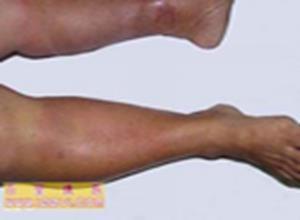 组织细胞吞噬性脂膜炎