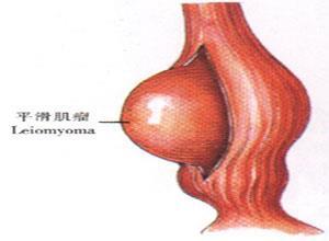 食管平滑肌瘤
