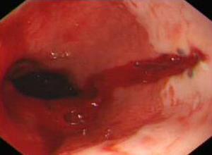 食管贲门粘膜撕裂综合征