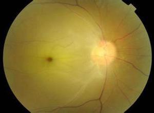 视网膜分支动脉阻塞