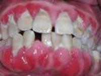 牙周膿腫