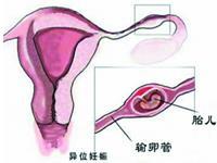 输卵管妊娠破裂