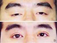 先天性睑裂狭小综合征