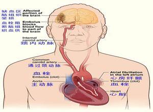 心血管和血栓栓塞综合征